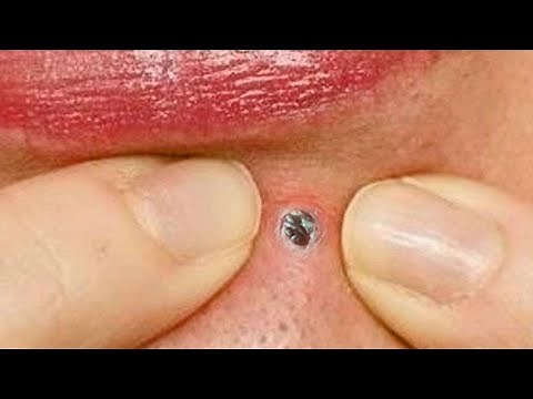 Dr. Popper's Pimple Popping Extravaganza!