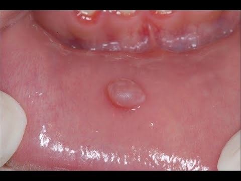 Mucocele (mouth blister): What is it, how to identify it, and what is the treatment?