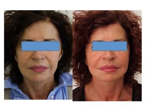 Ultraformer Effect - Before & After