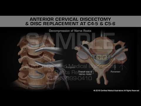 Anterior Cervical Discectomy & Disc Replacement at C4-5 & C5-6