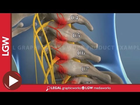 Cervical Radio Frequency Ablation animated surgery recreation