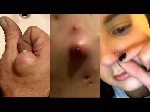 Big giant Pimple extraction & Cyst popping this week, blackheads, zits, acne popping compilation