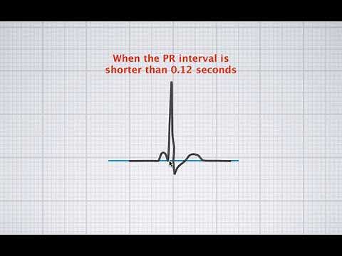 Interpreting ECG duration