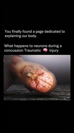 Explaining Our Body | A concussion isn’t “just a hit to the head.” When your skull suddenly stops, your brain keeps moving — smashing into the inside of your... | Instagram