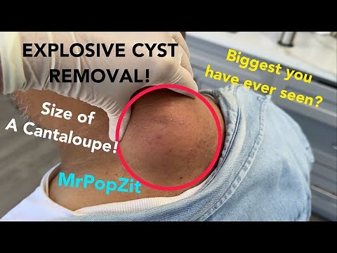 Gigantic cyst on neck! EXPLOSIVE POP. I remove entire sac with copious amounts of cyst material.