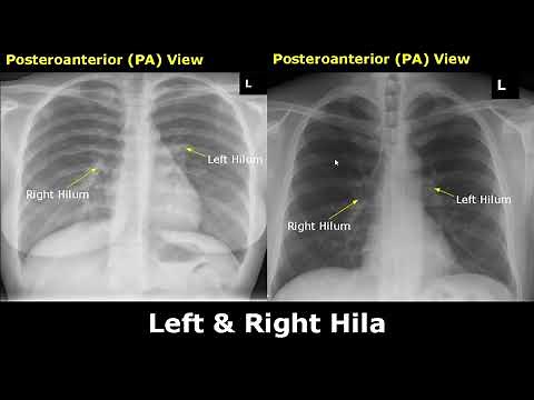 Normal Chest X-Ray Labelled Anatomy PA View Part 1: CXR Interpretation| Ribs/Heart/Lungs Radiography