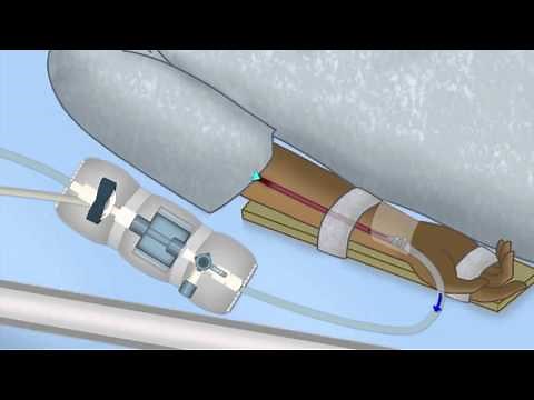 Interpreting Arterial Pressure Waveforms by J. DiNardo | OPENPediatrics