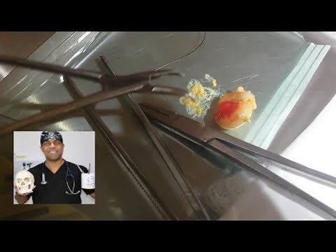 Sebaceous Cyst Explosion - Let's Pop One Open Close Up!