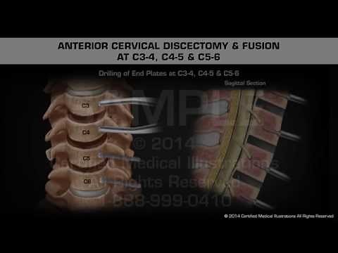 Anterior Cervical Discectomy & Fusion at C3-4, C4-5 & C5-6