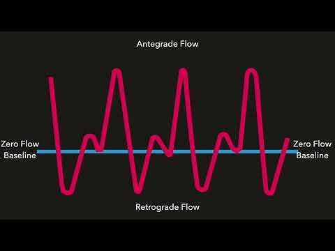 Doppler Flow Waveforms: Triphasic, Biphasic, Monophasic