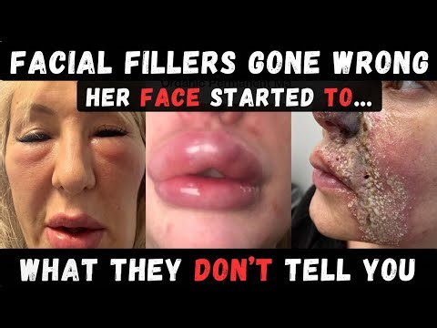 BOTCHED ⚠️ Facial FILLERS Horror Stories | Fillers Gone Wrong