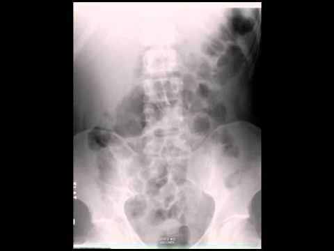 Left Lower Lobe Pneumonia in Abdominal X ray