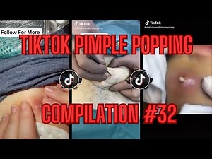 TikTok Pimple Popping Compilation - EP#32 (Cysts Explodes On Operating Table!)