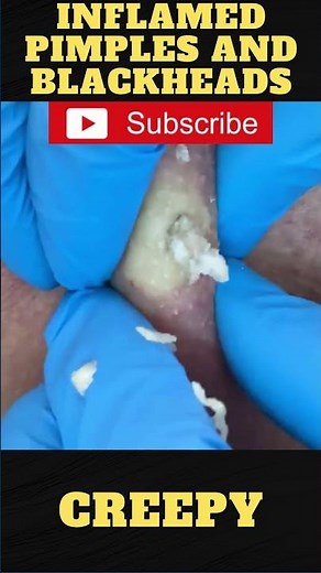 Giant Pimple Explosion Cyst Popping | Acne Pus Blackheads Bursting | ASMR Satisfying 09# 😱😱