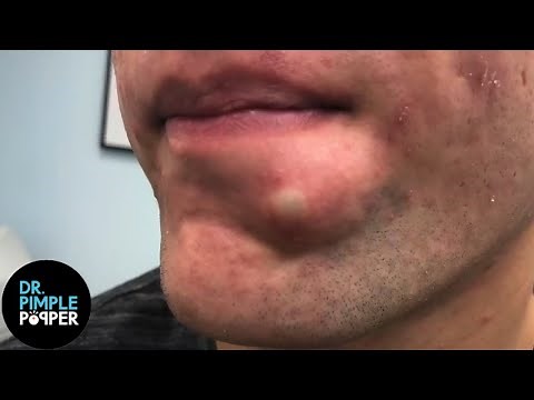 SATISFYING! Dr Lee Pops Inflamed Cyst on Chin | Dr Pimple Popper Reacts