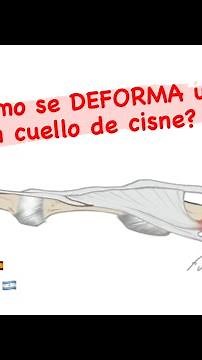 🦢 Sabes cómo se desarrolla una DEFORMIDAD de los DEDOS en cuello de CISNE❓