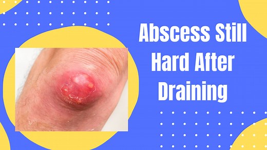 Abscess Still Hard After Draining: 3 Facts To Consider