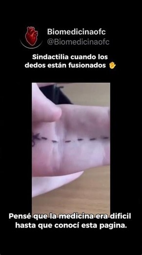 🚨 QUÉ ES LA SINDACTILIA Y POR QUÉ OCURRE EN LAS EXTREMIDADES 🖐🦶