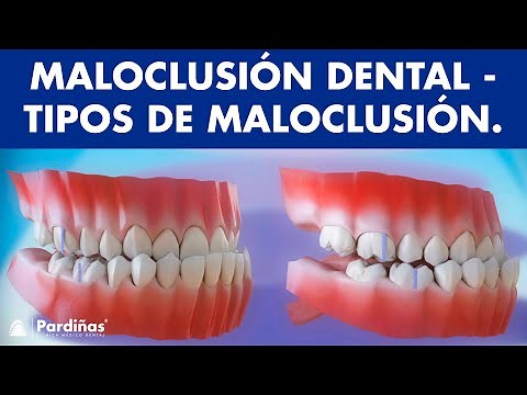 Maloclusión - ¿Cómo es la forma de correcta de la mordida? - Tipos de maloclusiones dentales ©