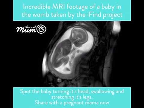 MRI Scan Video of Baby Moving in Womb | Channel Mum