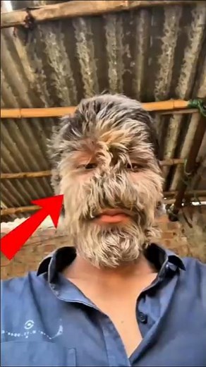 Real-Life Werewolves? 🐺 The Truth About Hypertrichosis #Shorts #WerewolfSyndrome #Medical