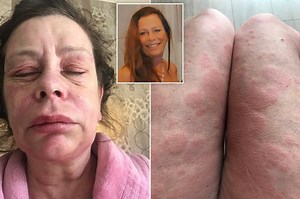UK woman says AstraZeneca COVID-19 vaccine turned her into ‘Alien’ monster