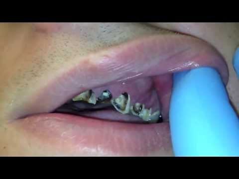 dental abscess