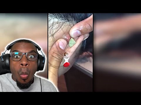 WATCH THESE GROSS CYST EXPLODE!! | Gross Cyst and Pimple Popping Compilation