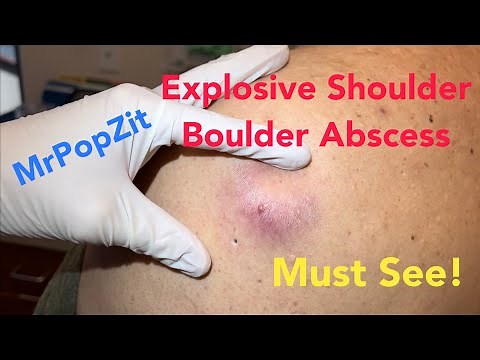 Explosive shoulder boulder abscess. You gotta see it to believe how much comes out of this pocket!