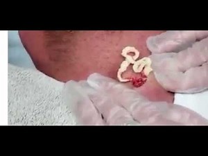 Pimple popper, cyst popper, zit explosion