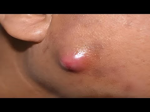 Cyst Explosion | Explosive cyst popping this week #cysts #ads