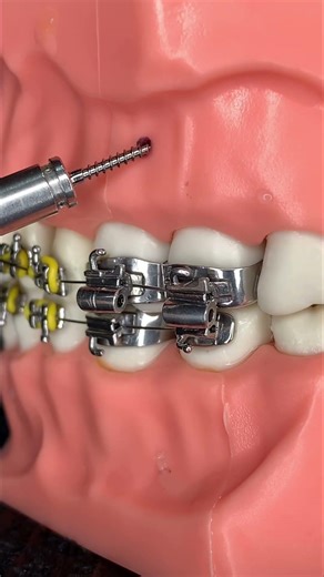 🔥Installation of Orthodontic Micro-Screws (Brackets)🔥