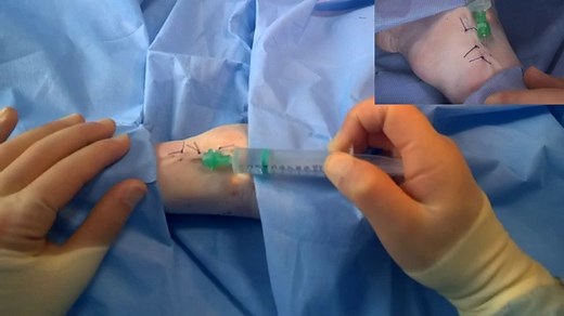 Infiltration of Local Anaesthetic - TeachMeSurgery