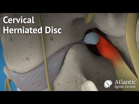 Cervical Herniated Disc