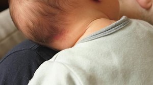 picor de cigüeña, beso de ángel, nevus simple, piel de recién nacidos con marca de nacimiento, cabeza de espalda, cuello