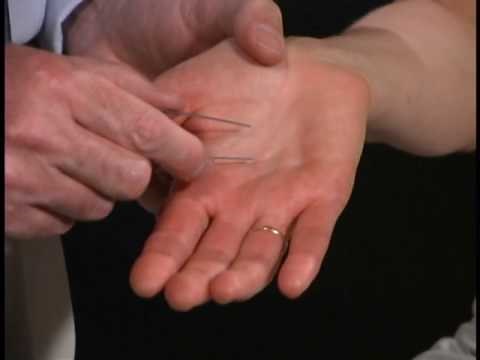 Normal Sensory Exam ; Two-Point Discrimination