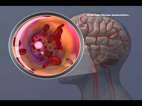 Ischemic Stroke Animation