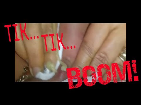 Small Cysts BIG Explosion - Back cyst explodes