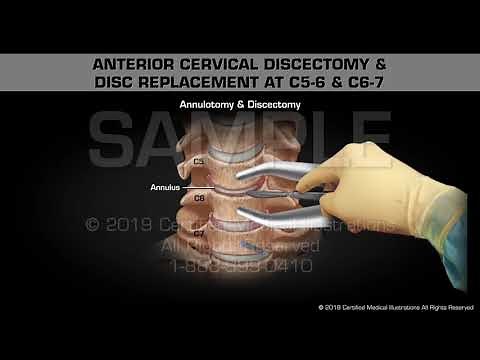 Anterior Cervical Discectomy & Disc Replacement at C5-6 & C6-7 - Medical Animation
