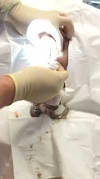 Exploding grapefruit sized sebaceous cyst popping.