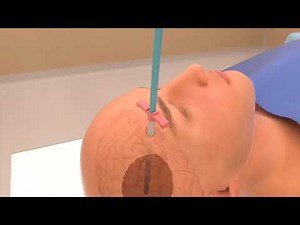 Artemis Neuro Evacuation device | A first in North Carolina