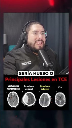 ⚠️ This is what a SUBDURAL HEMATOMA looks like (Lupita Villalobos case)