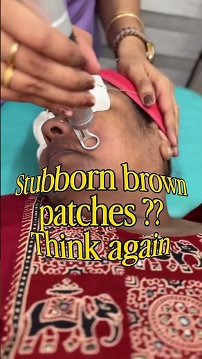 Dark Patches on Skin? It Could Be LPP, Not Regular Pigmentation