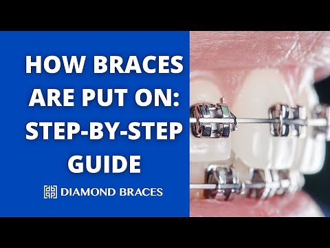 How Braces Are Put On: Step-by-Step with Dr. Drut | Diamond Braces