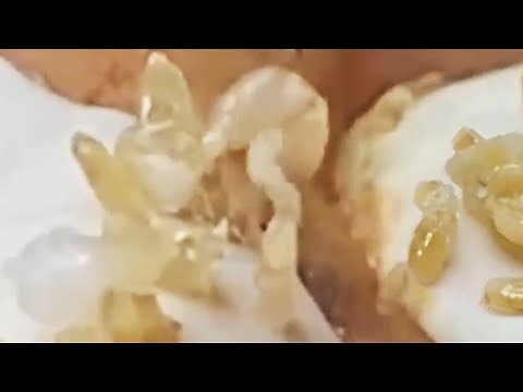 Deep blackhead extraction Cystic acne & pimple popping #15