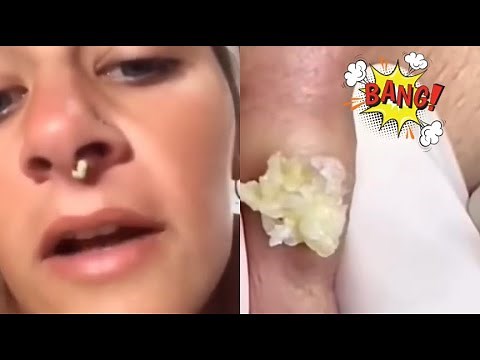 Super Satisfying Acne Removal Compilation: Best Pops, Blackheads, and Cyst Extractions