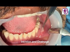 Incision and Drainage of Tooth Abscess Draining Pus • Video • MEDtube.net