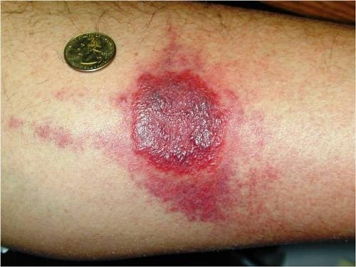 Bed Bug Bites Pictures: 30  Images, Symptoms & Treatment